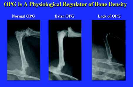 picture shows three x-rays of bones with varying bone densities due to application of OPG