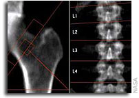 How Long Does It Take to Rebuild Bone Lost During Space Flight?